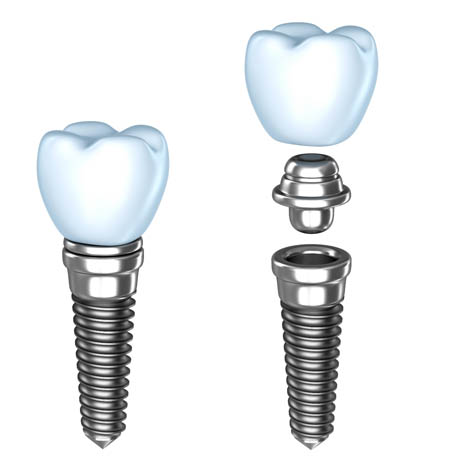 implants